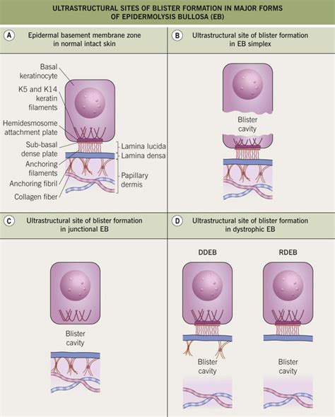 Epidermolysis Bullosa | Plastic Surgery Key