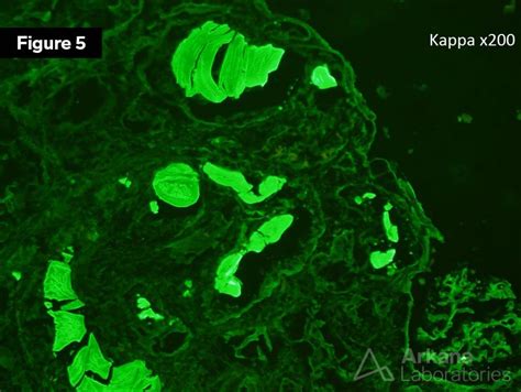 Kappa Light Chain Cast Nephropathy | Teaching Point | Arkana Labs