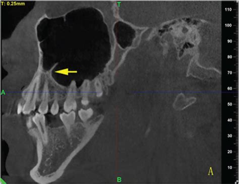 The location of maxillary sinus septa. (a), (b), (c), (d), (e) show the ...