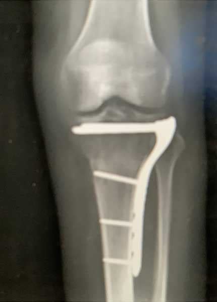 Tibial Plateau Fractures | Knee Surgeon | Minnesota