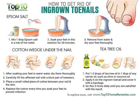 Before Thinking of Surgery, This is How to Get Rid of Ingrown Toenails ...