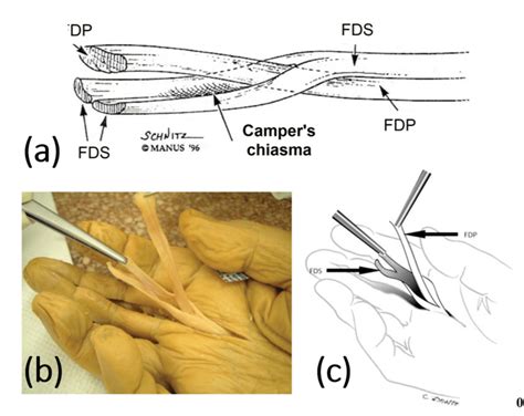 Relation between the FDP and FDS tendons. (a) Diagram showing the FDP... | Download Scientific ...