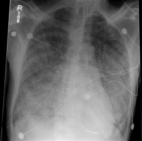 HIV AIDS chest x ray - wikidoc