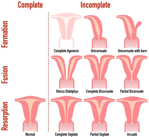 What is the relationship between uterine abnormalities and infertility? - Newlife IVF