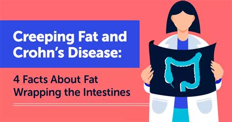 Creeping Fat and Crohn’s Disease: 4 Facts About Fat Wrapping the ...