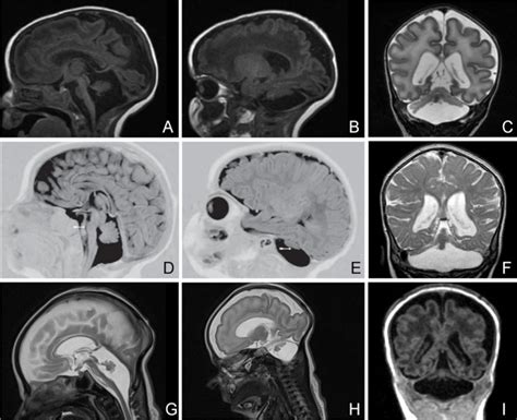 File:Pontocerebellar hypoplasia mri01.jpg - Embryology