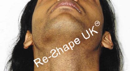 Malar/Cheek Implants for Cheek Augmentation – Before & After | Shape