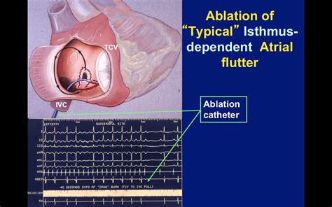 Atrial Flutter — 15 facts you may want to know.