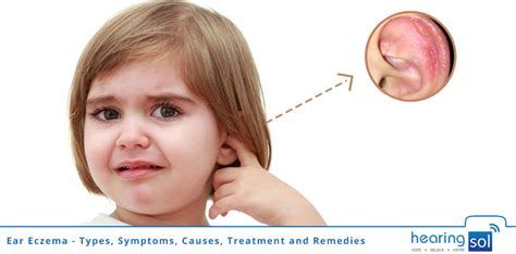 Ear Eczema - Symptoms, Causes, Treatment & Best Remedies