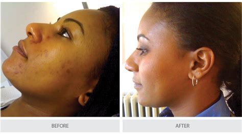 Before and After Skin Care Photos | Help to Stop, Cure Adult Acne