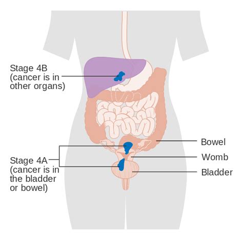 Stage 4 Endometrial Cancer Diagnosis - XpertPatient