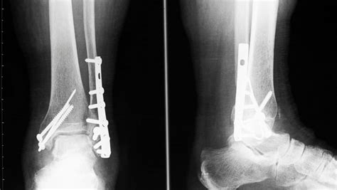 Lateral Malleolus Fracture Advice: FAQ on Lateral Malleolus Fractures