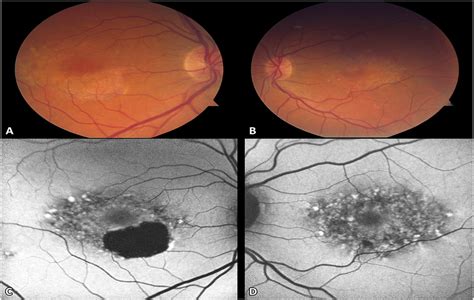 BULL'S EYE MACULOPATHY WITH MUTATIONS IN RDS/PRPH2 AND ROM-1 : Retinal ...