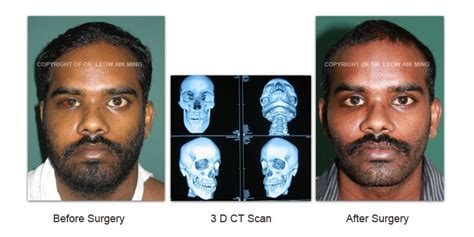 Craniofacial Trauma Reconstruction – MSPRS