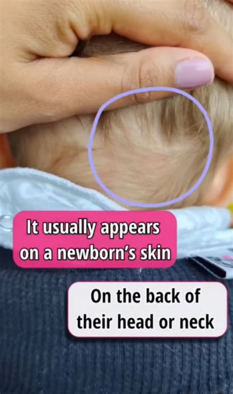 Does your baby has Stork Bite