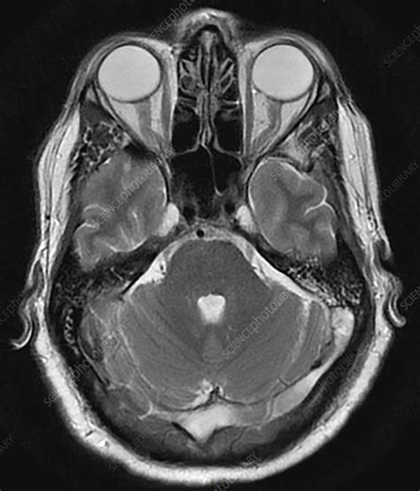 Extensive Dural Sinus Thrombosis, MRI - Stock Image - C036/5124 ...