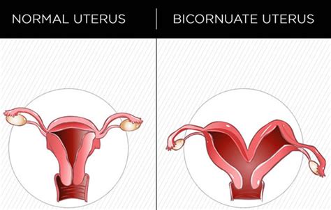 Bicornuate Uterus - Causes, Symptoms, Ultrasound, Fertility & Pregnancy