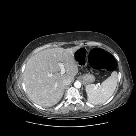 Anastomosis leak at ileostomy closure site | Radiology Case ...