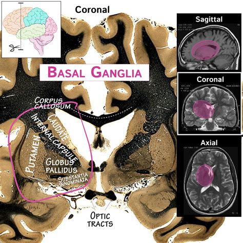 Neuroanatomy Glossary: Basal nuclei (basal ganglia) and related ...