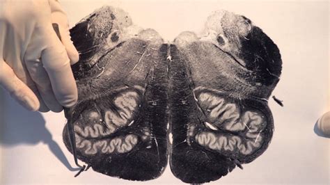 Neuroanatomy Video Lab - Brain Dissections: Brain Stem & Reflexes - The ...