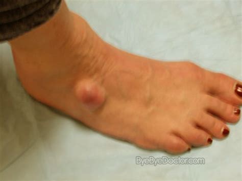 Ganglion Cyst Ankle