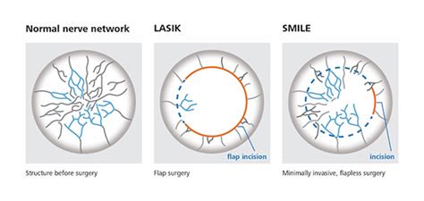 SMILE or LASIK? Comparing 5 aspects of 2 vision correction surgeries | Nebraska Medicine Omaha, NE