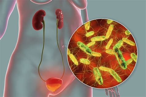 Asymptomatic bacteriuria in institutionalized elderly