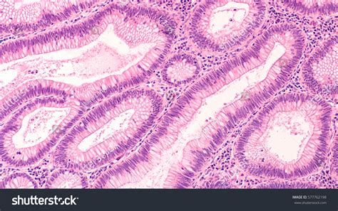 288 Colon Adenomas Images, Stock Photos & Vectors | Shutterstock