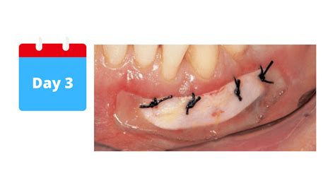 The different healing stages of a gum graft (Day by Day Pictures)