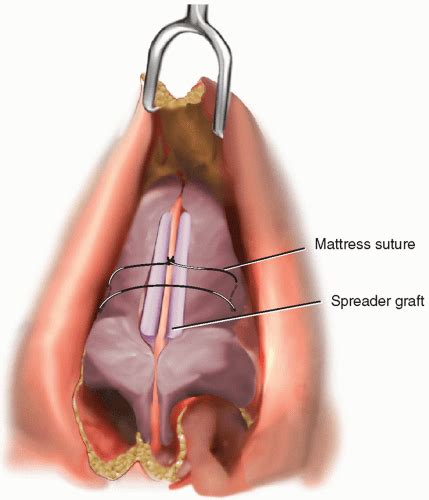 Surgery for The Nasal Valve | Ento Key