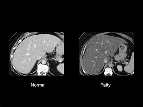 Normal Ct Scan Abdomen