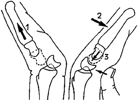 Treatment of Acute Lunate and Perilunate Dislocations - Journal of Hand Surgery