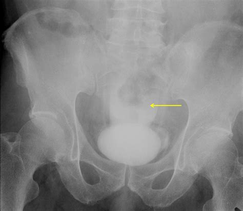 Retrograde cystography findings of contrast medium extravasation (arrow ...