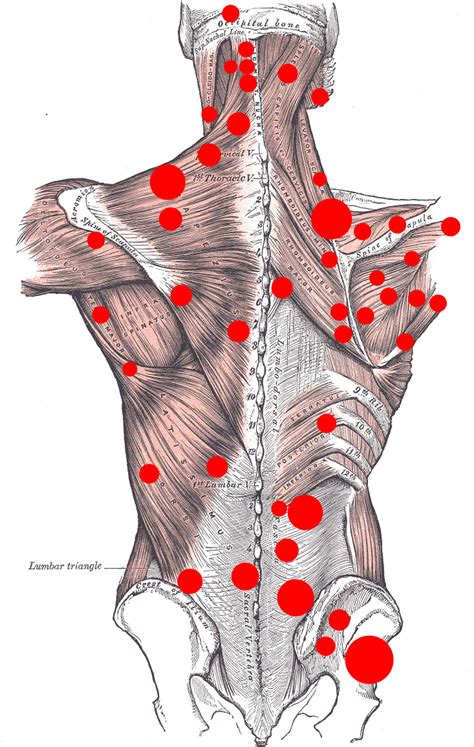 Trisoma® - Ending the Cycle of Myofascial Pain® - Trigger Point Therapy ...