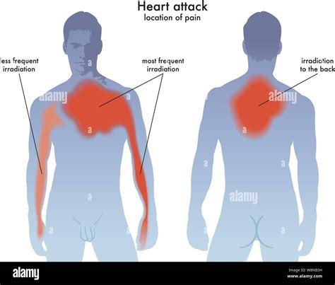 Myocardial attack Stock Vector Images - Alamy