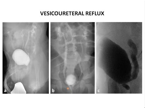 Voiding cystourethrogram (VCUG) in three different patients. (a), (b)... | Download Scientific ...