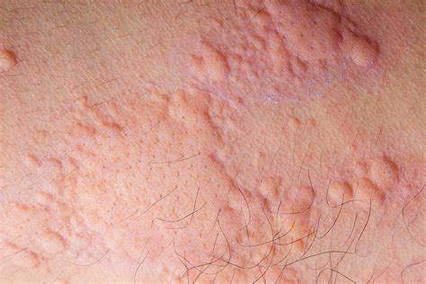 7 Common Types of Skin Rashes in the Philippines