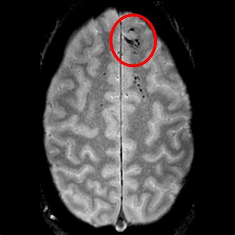 MRI links head trauma microbleeds to clinical outcome﻿ - Scan For Life