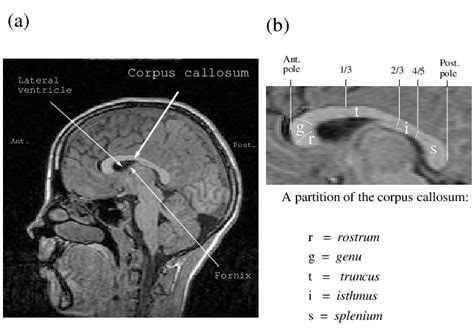 (a) Midsagittal, T1-weighted MRI section of the brain (12 year old boy)... | Download Scientific ...