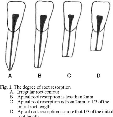 Figure 1 from Risk factors of root resorption after orthodontic treatment. | Semantic Scholar