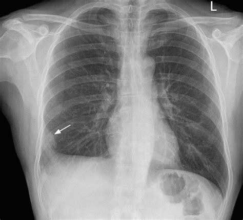 Radiographie Pulmonaire Embolie Pulmonaire - Image to u