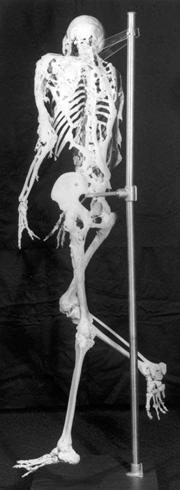 Pathology Outlines - Fibrodysplasia ossificans progressiva