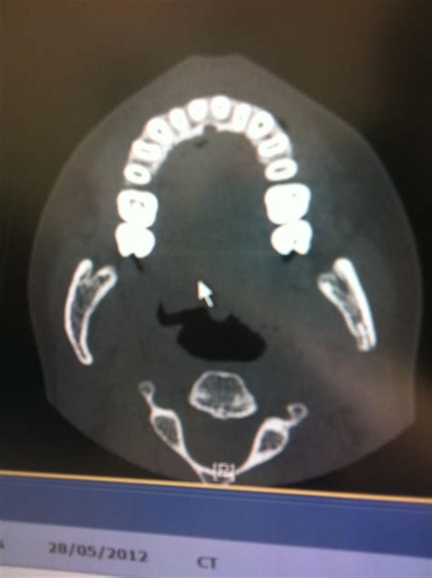 A Guide to Surviving Orthognathic Surgery: Sinus Infections after Surgery