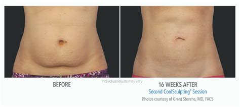 CoolSculpting before and after | Real Patient Photos - Vein & Laser Institute