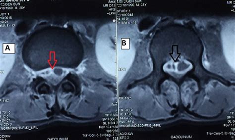 Cureus | Spinal Epidural Abscess in Melioidosis: A Rare Case Report from Eastern India