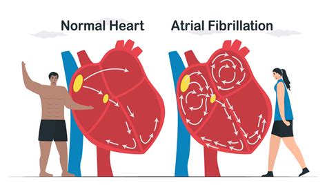 What Is Atrial Fibrillation? - Advara HeartCare