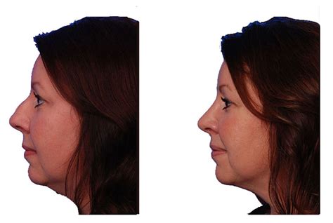 How to Remove a Dorsal Hump (Nose Bump) — SKY Facial Plastic Surgery