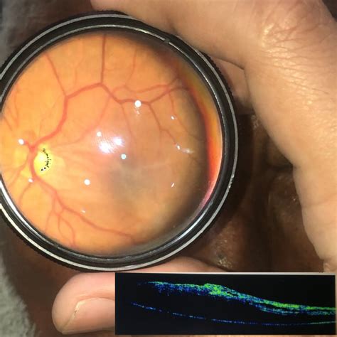 Macular puckering - American Academy of Ophthalmology