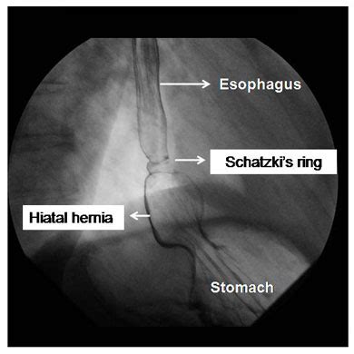 Schatzki' s Ring Diagnosis