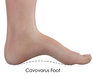 Cavovarus Foot Deformity Sydney, NSW | Ankle Sprains & Bone Deformities Randwick